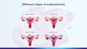 different stages of endometriosis