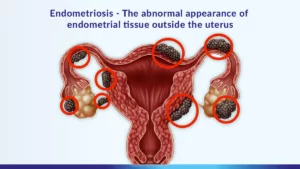 what is endometriosis