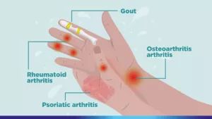 different types of arthritis in hands