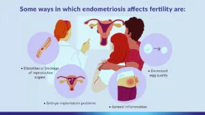 endometriosis and infertility