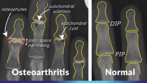 osteoarthritis in hands x-ray