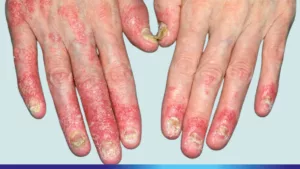 psoriasis and arthritis in hands