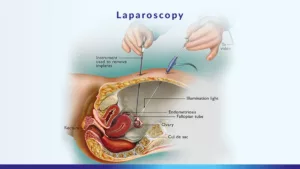 endometriosis fertility treatment - laparoscopy