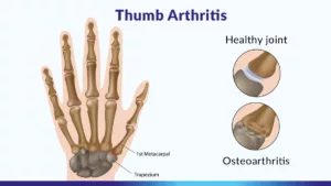 arthritis in hands - thumbs